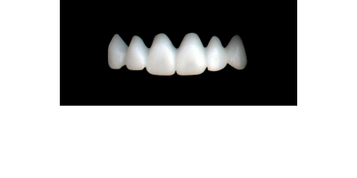 Cod.S8UPPER ANTERIOR : 10x  solid (not hollow) wax bridges, SMALL, Tapering ovoid, (13-23), compatible to Cod.E8UPPER ANTERIOR (hollow), (13-23)